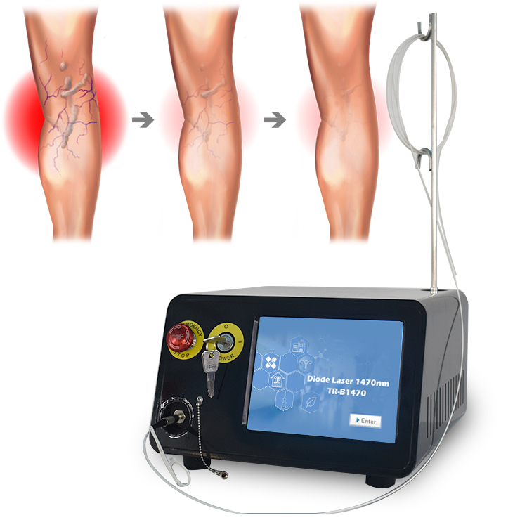 1470 diode laser evlt varicose veins ablation varicose veins laser treatment machine