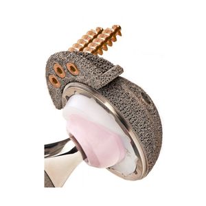 3D printed Titanium Acetabular titanium augment for revision surgery, 3D customized hip joint implant acetabulum