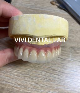 Implant Pfm Bridge - China Dental Lab of Good Quality and Professional Technicians