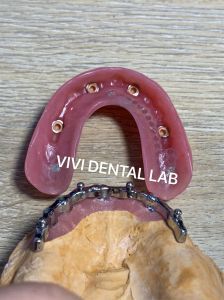 Implant Bar with Ball Attachments - China Dental Lab, Good Quality and Good Esthetics