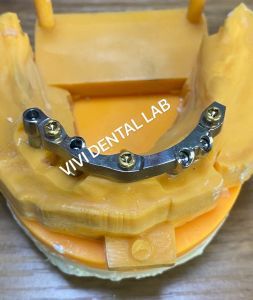 Implant Bar - China Dental Lab Digital Designed and Milled Titanium Bar with Attachments