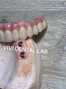 Implant Screwed Bridge - China Dental Lab Implant Crown in Good Quality and Good Esthetics