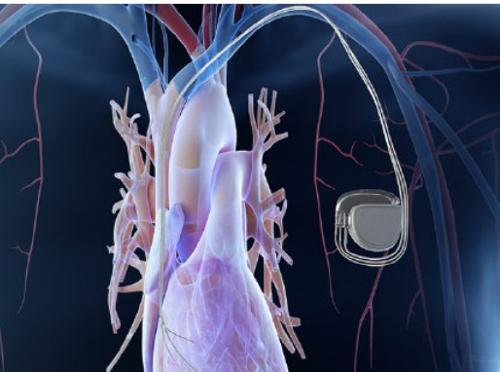 Implantable Medical Devices - Implantable Medical Devices - Components & Assemblies