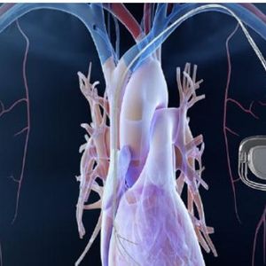 Implantable Medical Devices - Implantable Medical Devices - Components & Assemblies