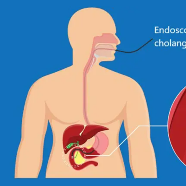 Endoscopic retrograde cholangiopancreatography (ERCP)