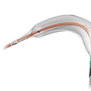 NSE™ PTA (peripheral scoring balloon catheter)