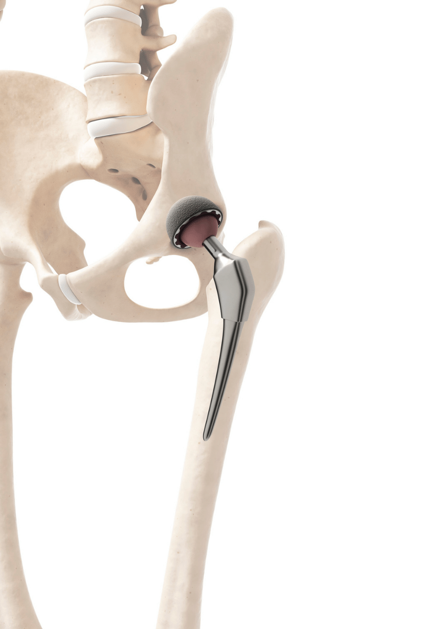 HIP PROSTHESIS