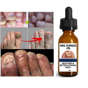 Customized Nail Fungus Oil Beautiful Healthy Nail Care Nail Fungal Treatment Serum for Hand Foot Removal Repair Gel