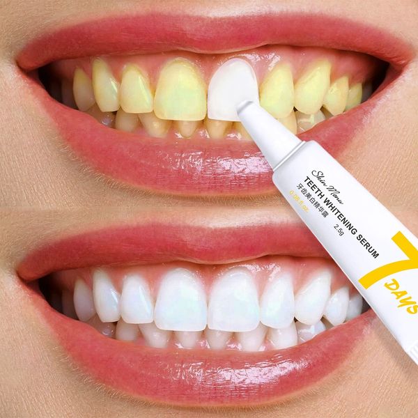 2024 Wholesale Sodium phytate phytic acid Professional 2.5G*7 pcs Secondary throw type Teeth Whitening Gel Dental Bleaching Gel